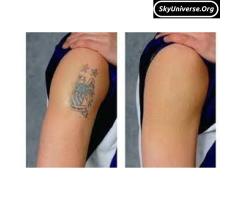 Tattoo removal cream,and spray+256777422022 - 2
